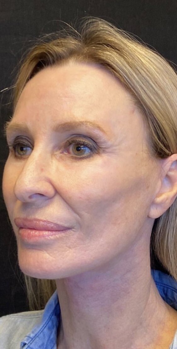 Deep Plane Facelift Before & After Image