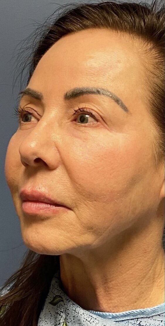 Deep Plane Facelift Before & After Image