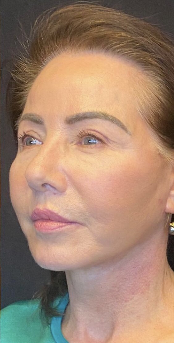 Deep Plane Facelift Before & After Image