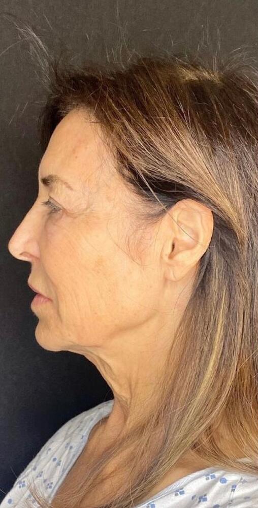 Deep Plane Facelift Before & After Image