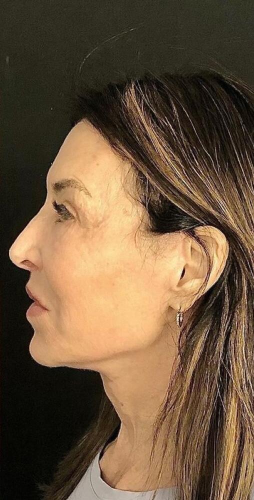 Deep Plane Facelift Before & After Image