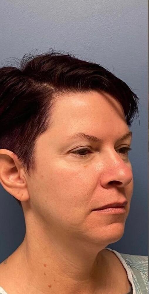 Deep Plane Facelift Before & After Image