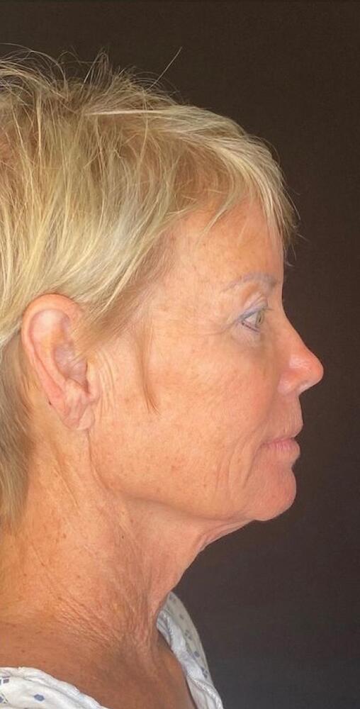 Deep Plane Facelift Before & After Image