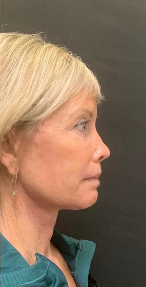 Deep Plane Facelift Before & After Image