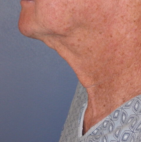 Direct Neck Lift Before & After Image