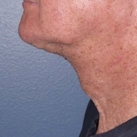 Direct Neck Lift Before & After Image