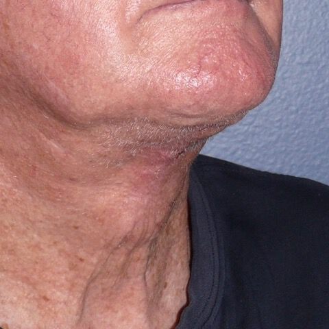 Direct Neck Lift Before & After Image