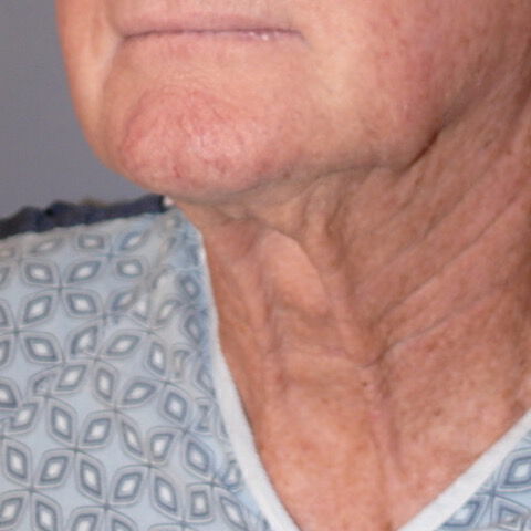 Direct Neck Lift Before & After Image