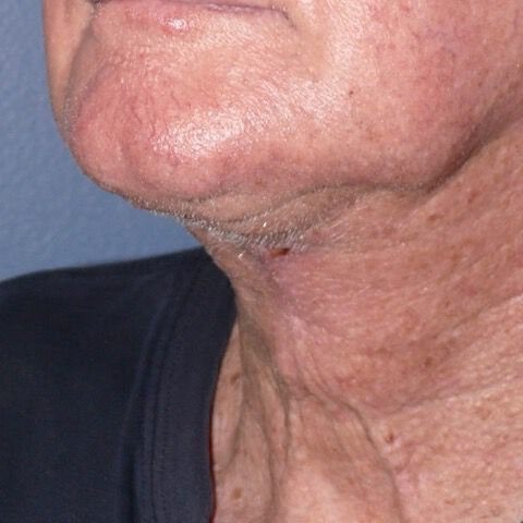 Direct Neck Lift Before & After Image