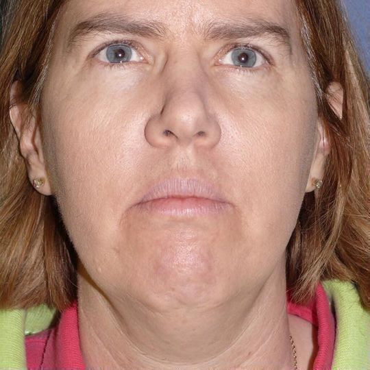 Direct Neck Lift Before & After Image