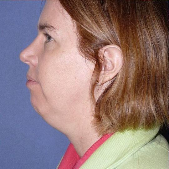 Direct Neck Lift Before & After Image