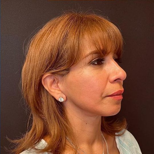 Direct Neck Lift Before & After Image