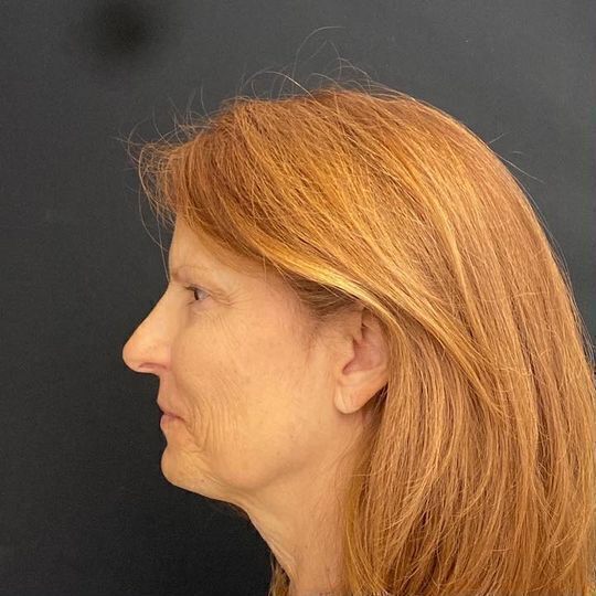 Direct Neck Lift Before & After Image