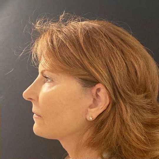 Direct Neck Lift Before & After Image