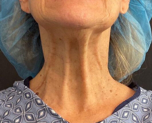 Direct Neck Lift Before & After Image