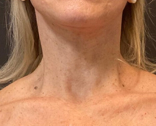 Direct Neck Lift Before & After Image