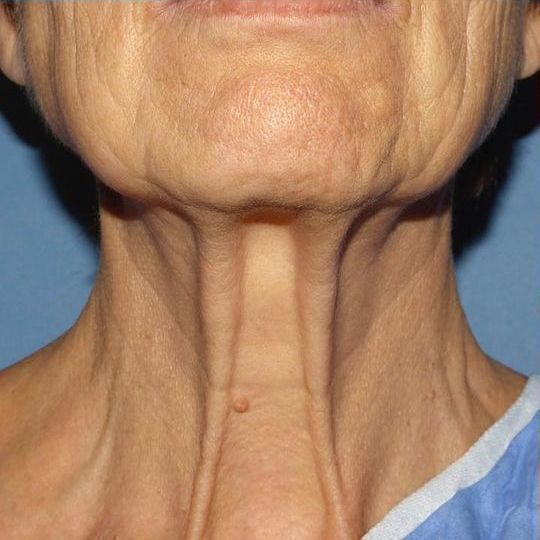 Direct Neck Lift Before & After Image