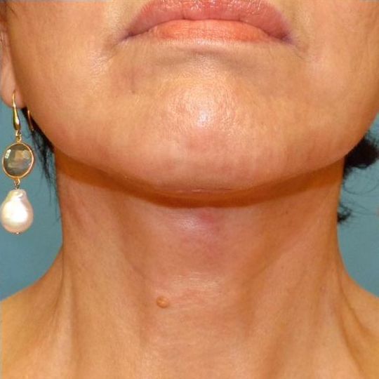 Direct Neck Lift Before & After Image