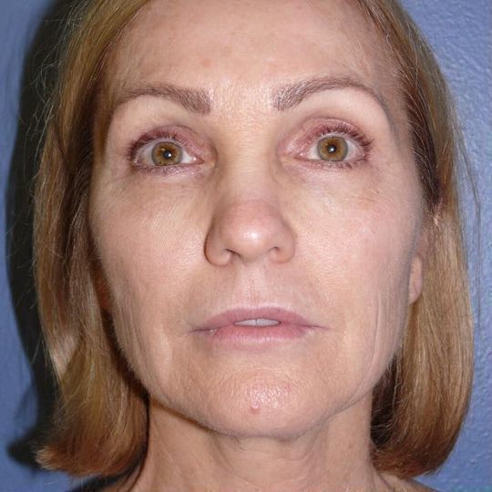 Direct Neck Lift Before & After Image