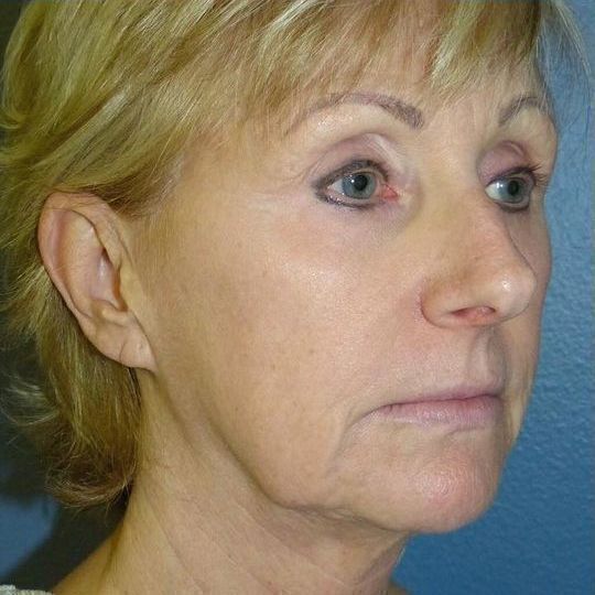 Direct Neck Lift Before & After Image