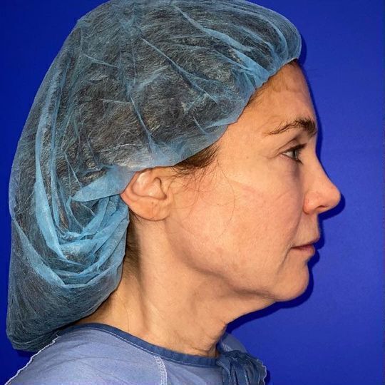 Direct Neck Lift Before & After Image