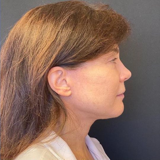 Direct Neck Lift Before & After Image