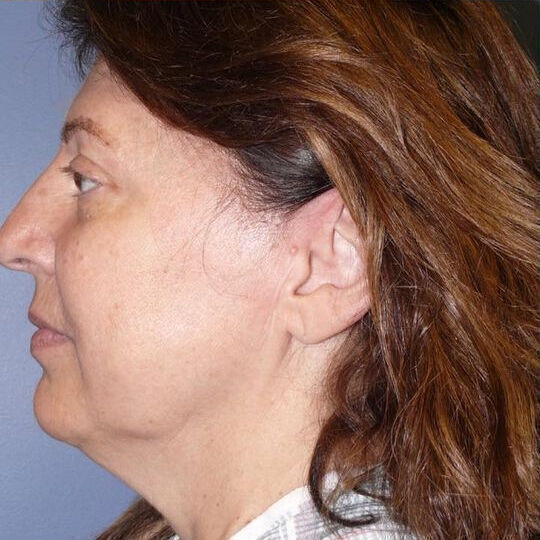 Direct Neck Lift Before & After Image