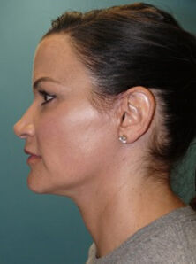 Facelift Before & After Image