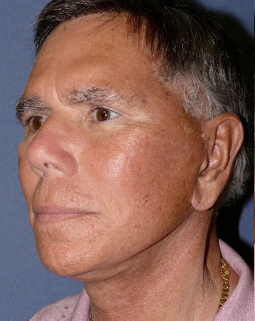 Facelift Before & After Image