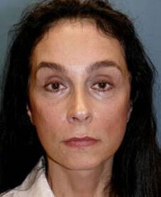 Facelift Before & After Image