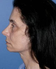 Facelift Before & After Image