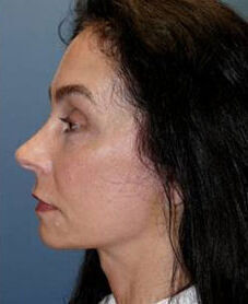 Facelift Before & After Image