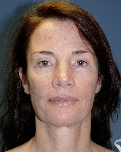 Facelift Before & After Image