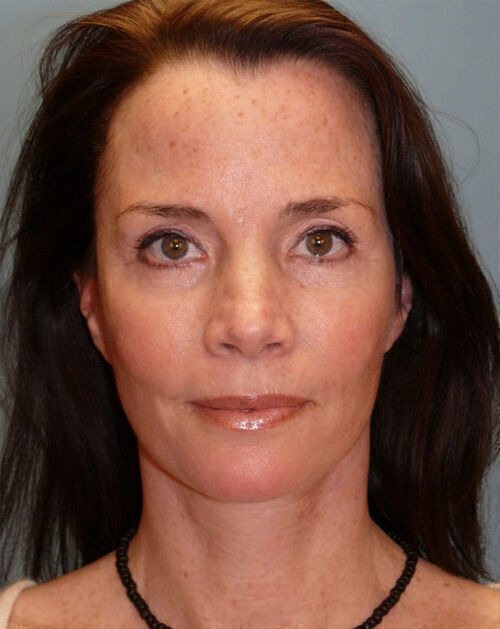 Facelift Before & After Image