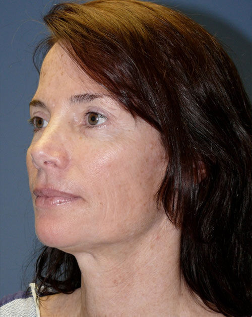 Facelift Before & After Image