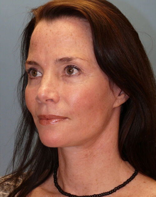 Facelift Before & After Image