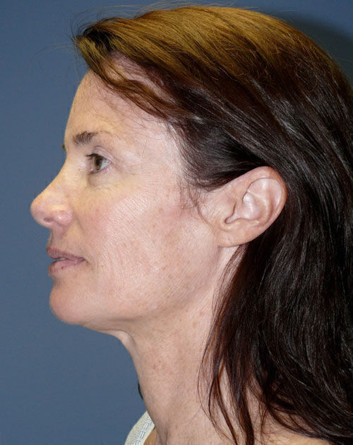 Facelift Before & After Image