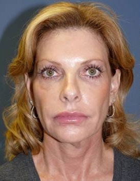 Facelift Before & After Image