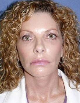 Facelift Before & After Image