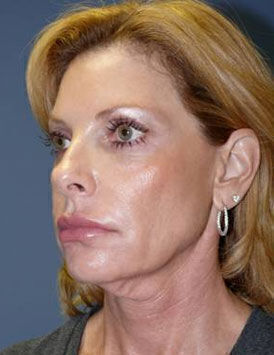 Facelift Before & After Image