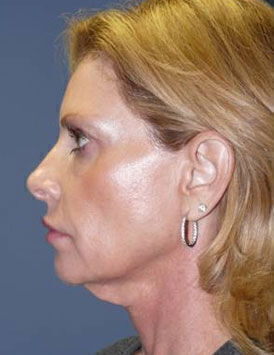 Facelift Before & After Image