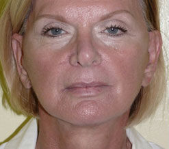 Facelift Before & After Image