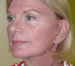 Facelift Before & After Image