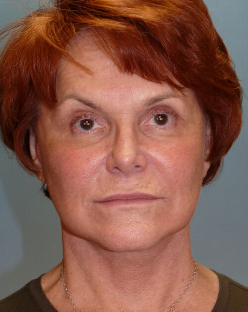 Facelift Before & After Image