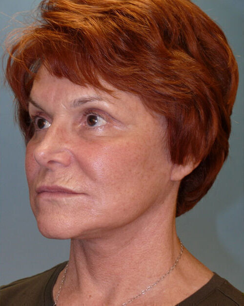 Facelift Before & After Image