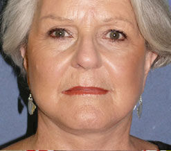 Facelift Before & After Image