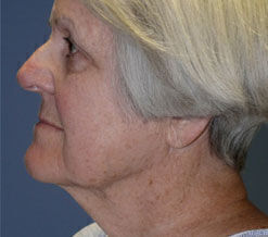 Facelift Before & After Image