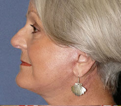 Facelift Before & After Image