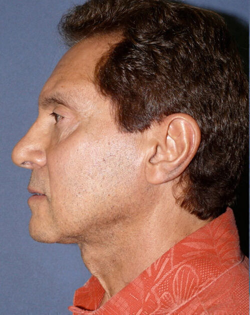 Facelift Before & After Image