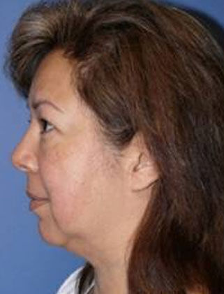 Facelift Before & After Image